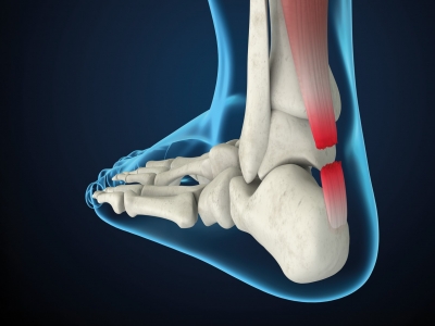 Stark und doch anfällig: Die Achillessehne