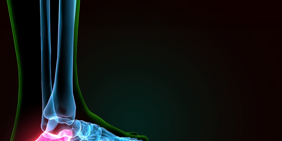 Wenn der Fuß Entlastung braucht: Der Fersensporn